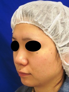 術前　右前斜位